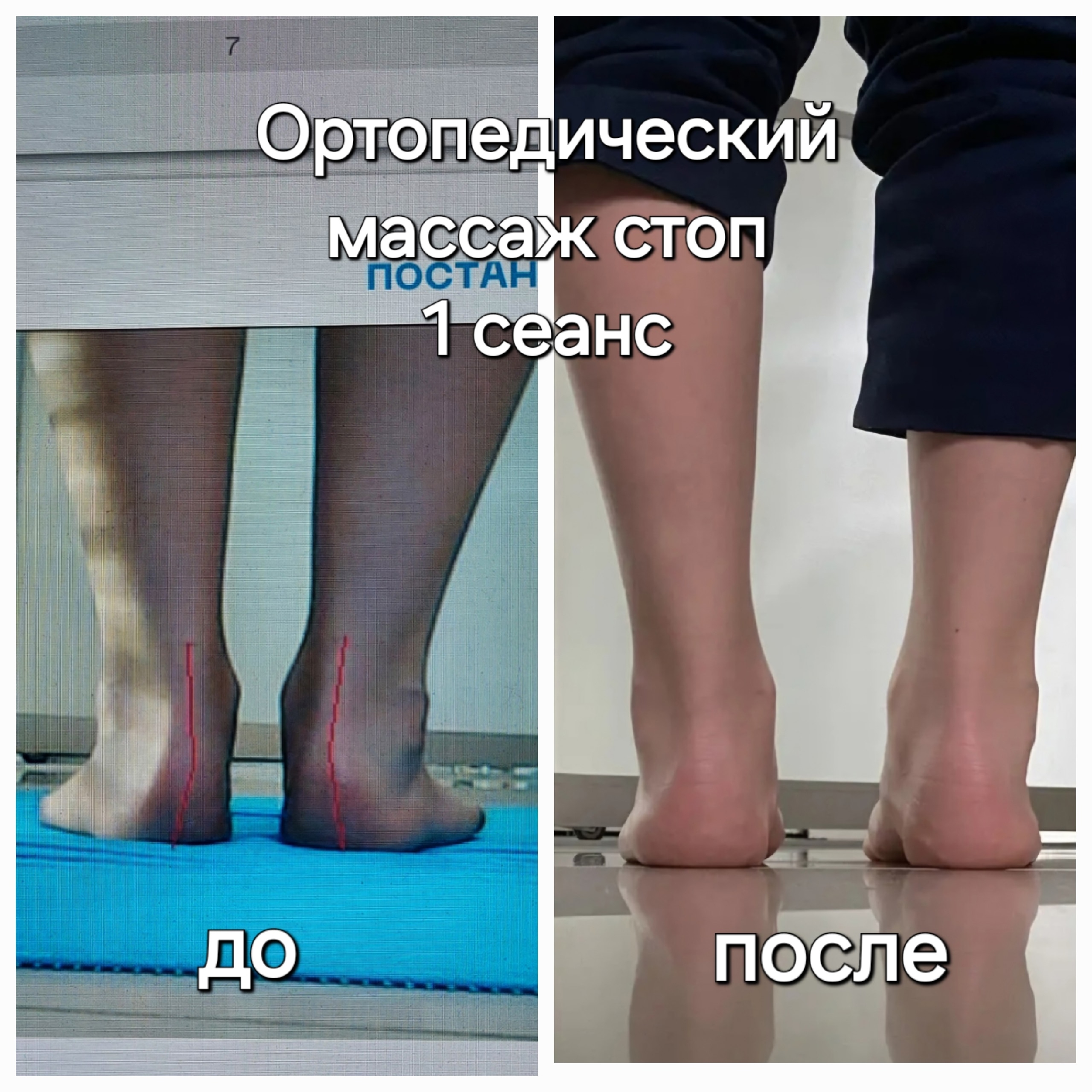 Ортопедический (Фрикционный)  массаж стоп©